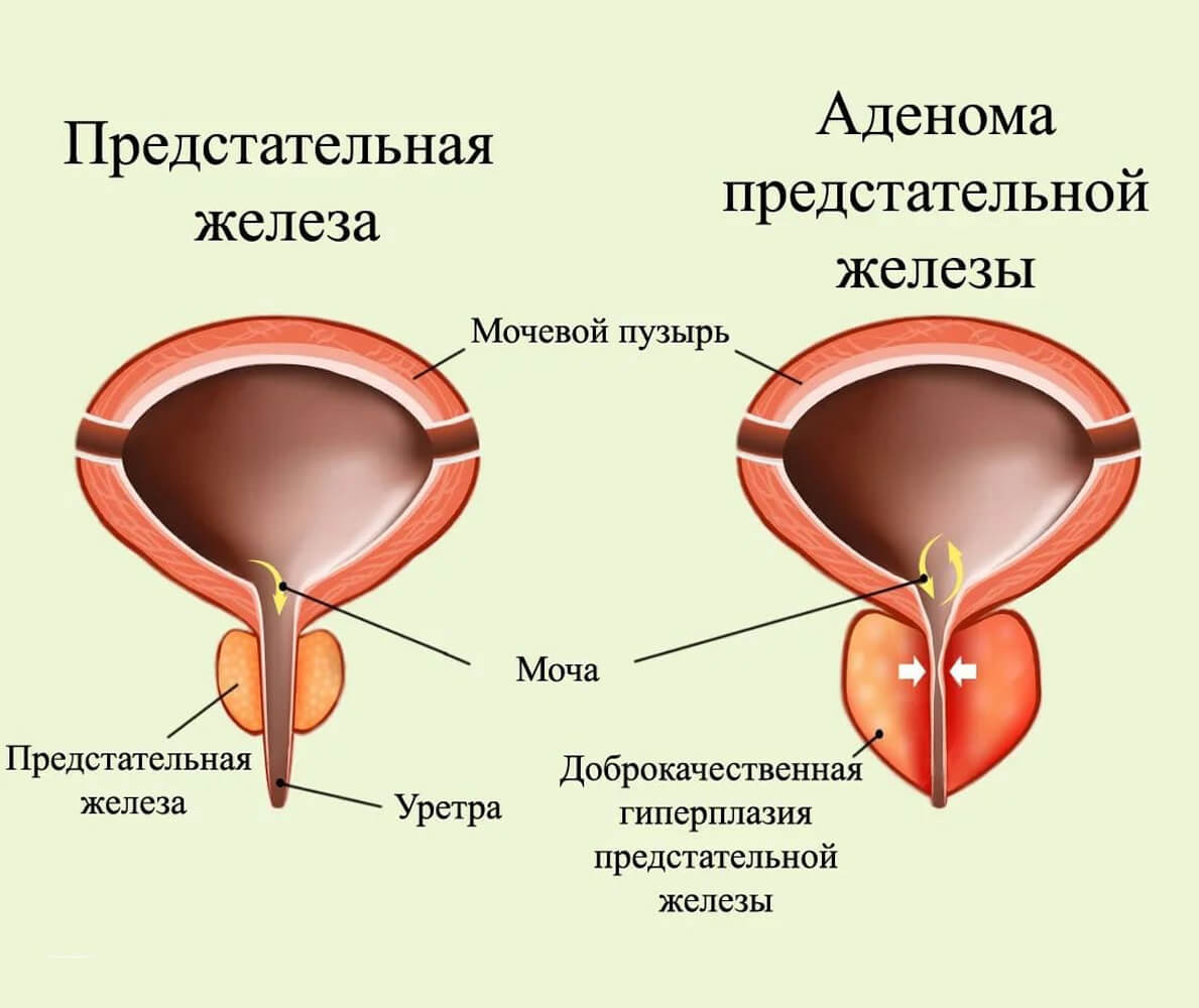 Простой предстательной железы. Гиперплазия предстательной железы. Аденома предстательной железы. Аденома простаты железы. Доброкачественная гиперплазия предстательной железы.